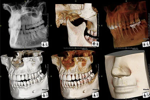 レントゲン写真