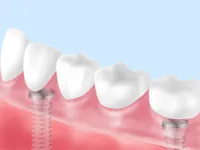 マグネットデンチャー