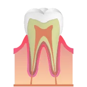 CO（初期のむし歯）