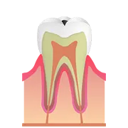 C1（エナメル質のむし歯）