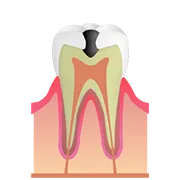 C2（象牙質のむし歯）