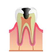 C3（神経のむし歯）
