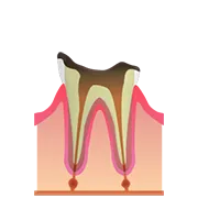C4（歯根のむし歯）