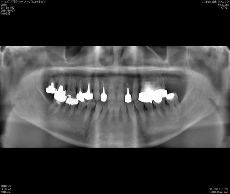 治療前レントゲン