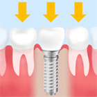 歯を失った部分の顎の骨にチタン製の人工歯根（インプラント）を埋入し、その上に人工歯を装着させる