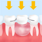 失った歯の本数に応じて、部分入れ歯や総入れ歯を作製し、装着させる