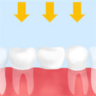 歯を失った部分の両隣の歯を削り、それを土台として人工歯を装着させる