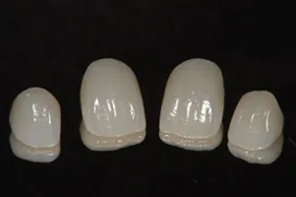 オールセラミック